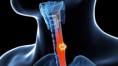 سرطان المريء.. الأسباب والأعراض وطرق العلاج
