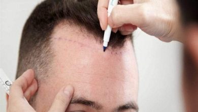 حقائق ومعلومات مهمة حول زراعة الشعر