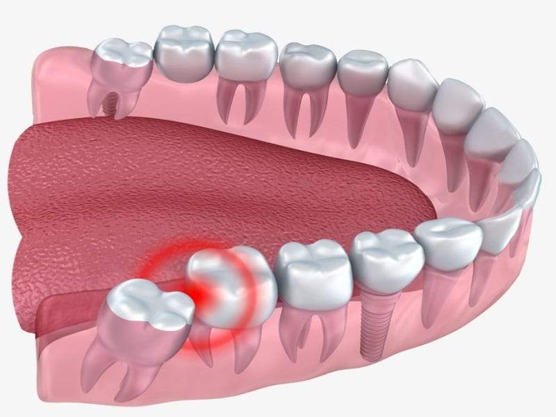 مشاكل ضرس العقل وعلاجه