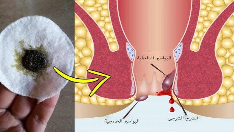 علاج الشرخ الشرجي