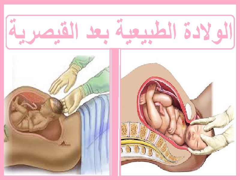 الولادة الطبيعية بعد القيصرية